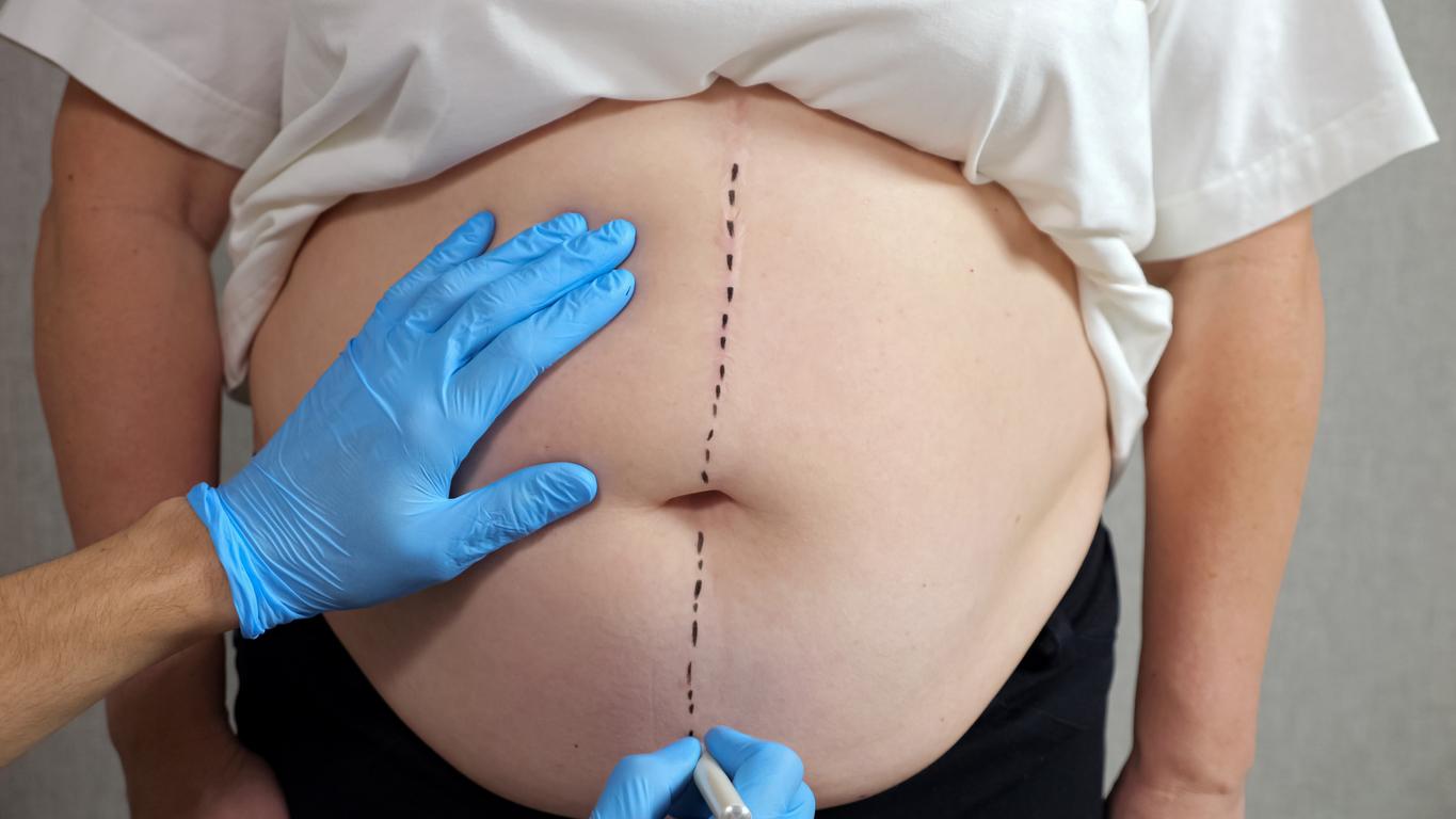 5 inconvénients de la chirurgie bariatrique
